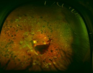 Diabetic-Retinopathy_Before-300x236