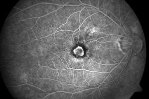 Macular Degeneration