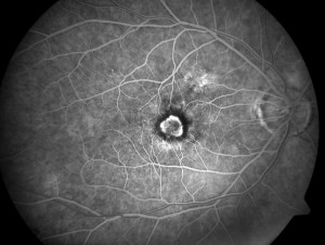 Macular Degeneration