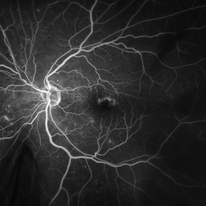 Diabetic Retinopathy